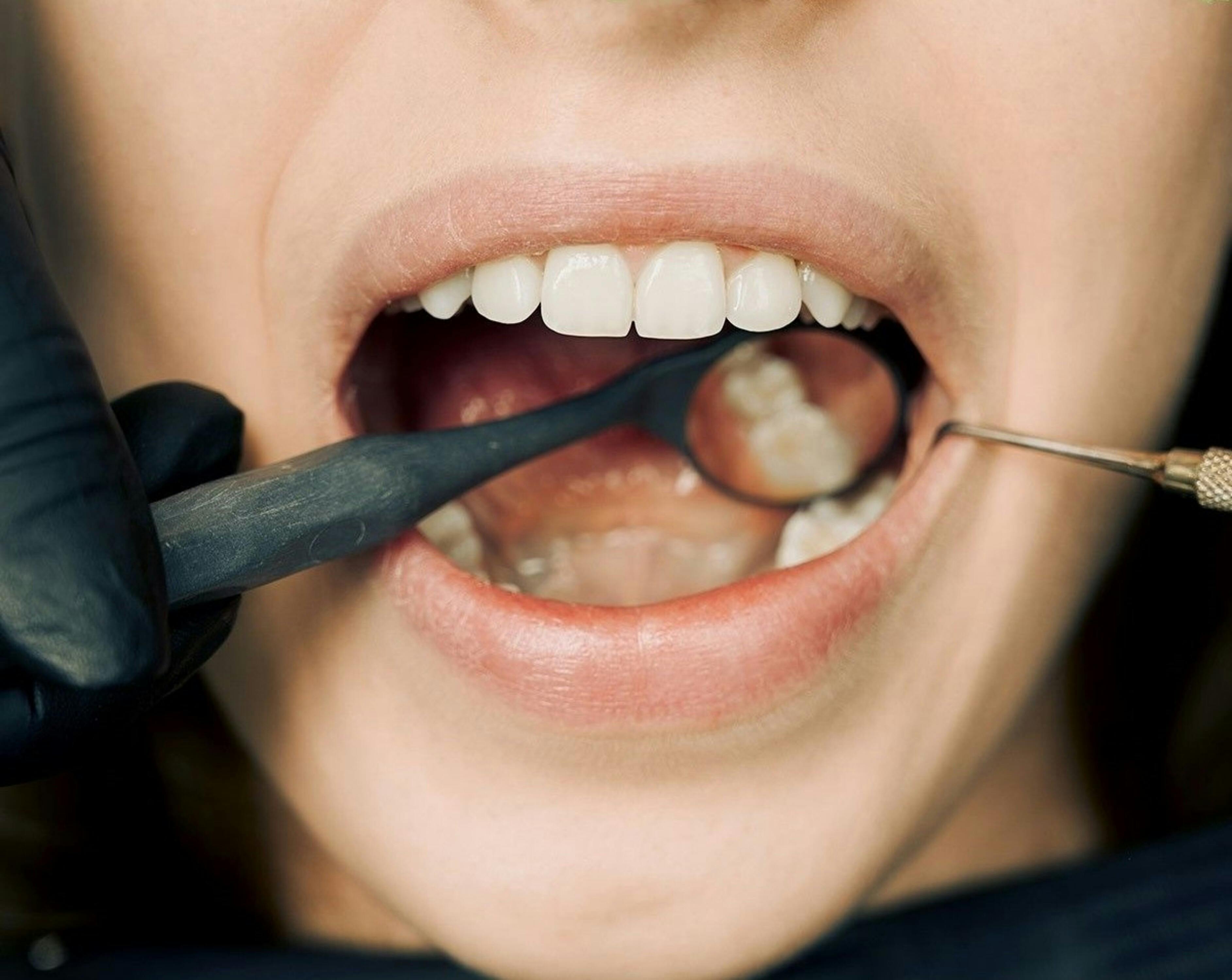 ¿Cuánto Tiempo Dura el Tratamiento de la Periodontitis?